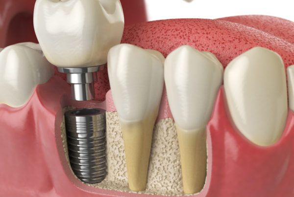 360 implant