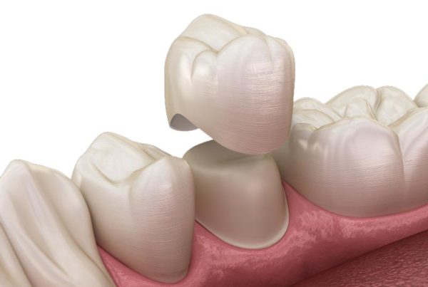 Dental Crowns in Turkey