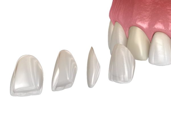 Dental Veneers in Turkey Front and Back View