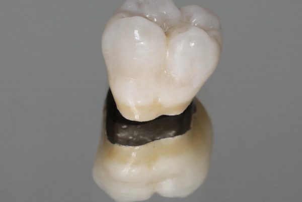Porcelain Metal Crowns in Turkey